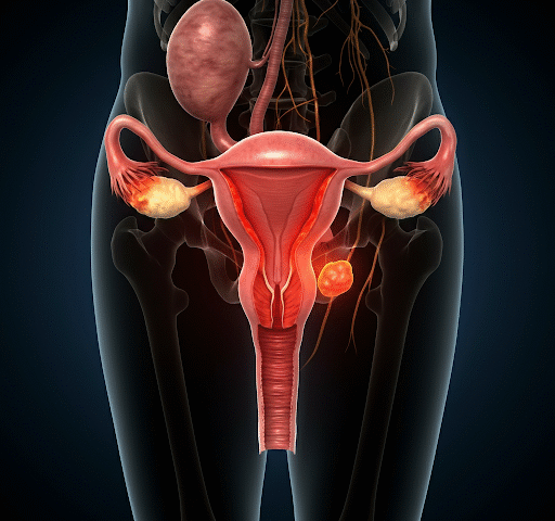 uterus_infection