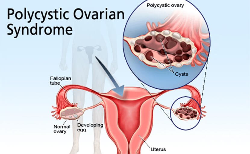 ovarian_cyst_symptoms