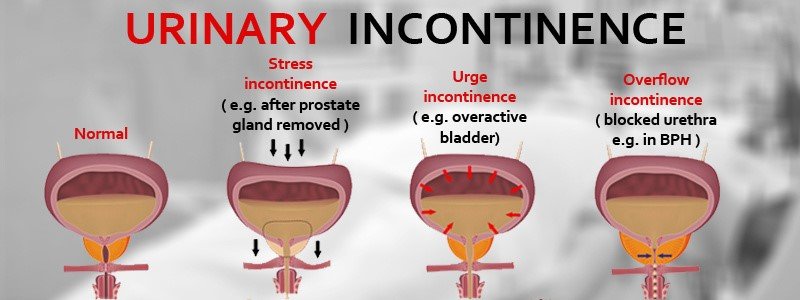 urinary_incontinence