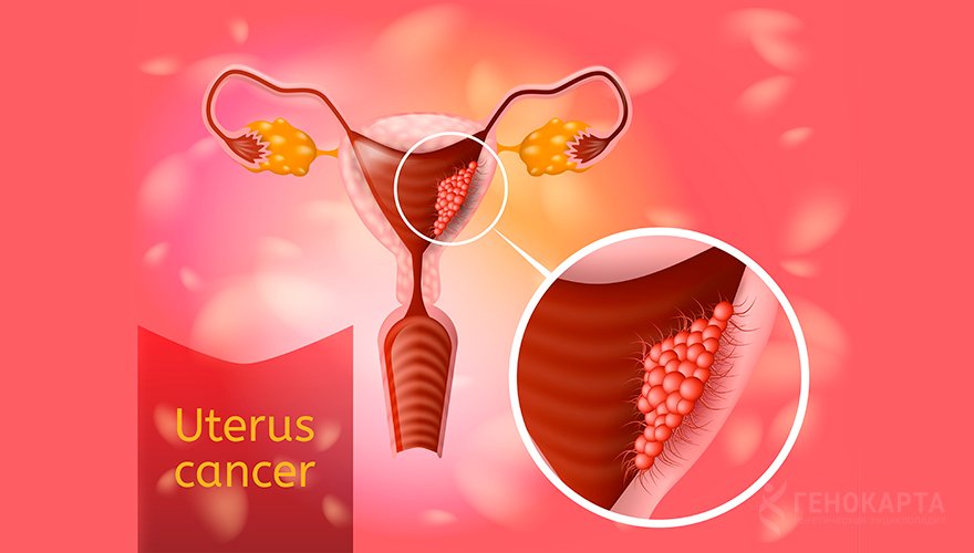 uterus_ cancer