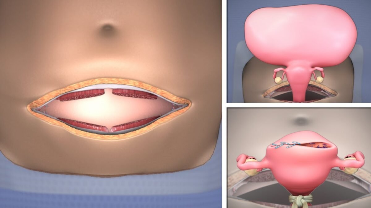 total_laproscopic_hysterectomy
