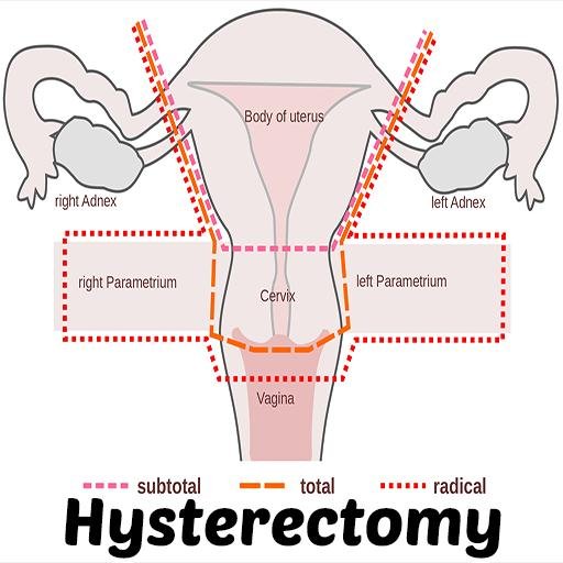 non-descent-vaginal-hysterectomy