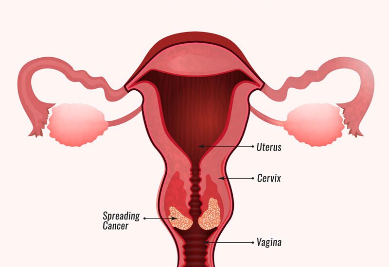 cervical_cancer