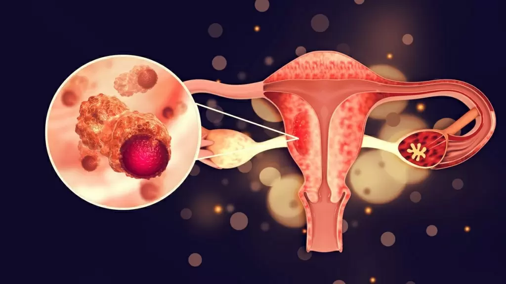 ovarian_tumor