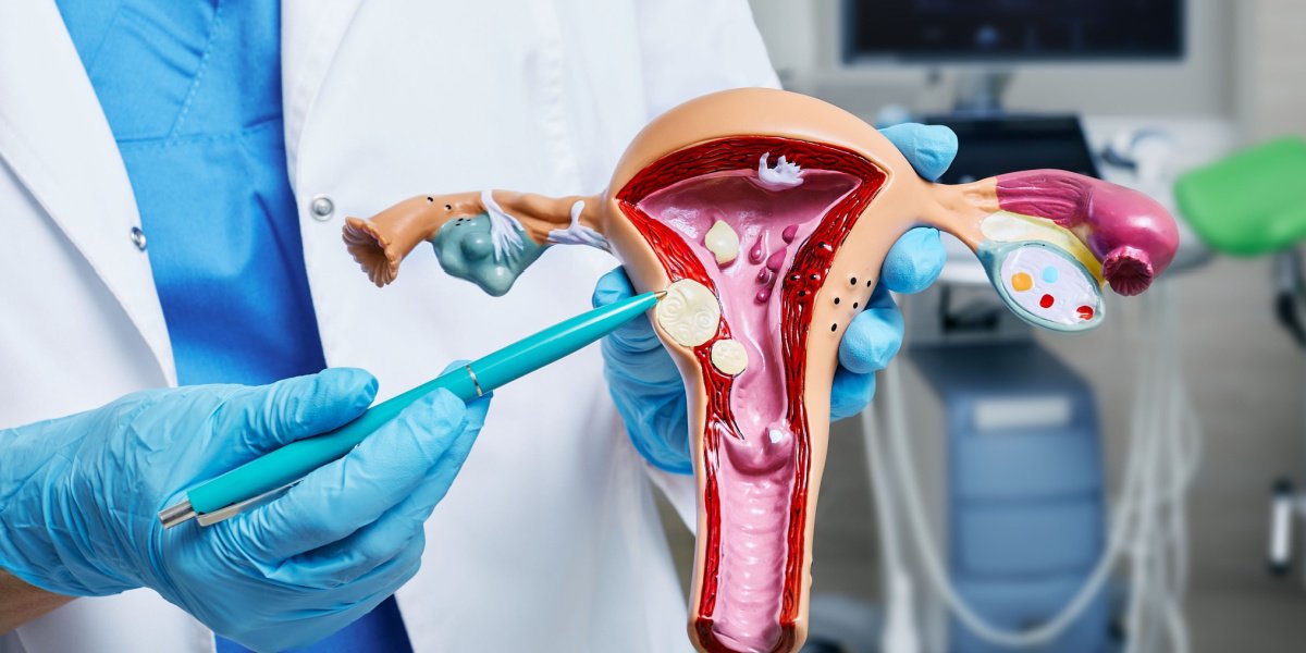 uterine_fibroids